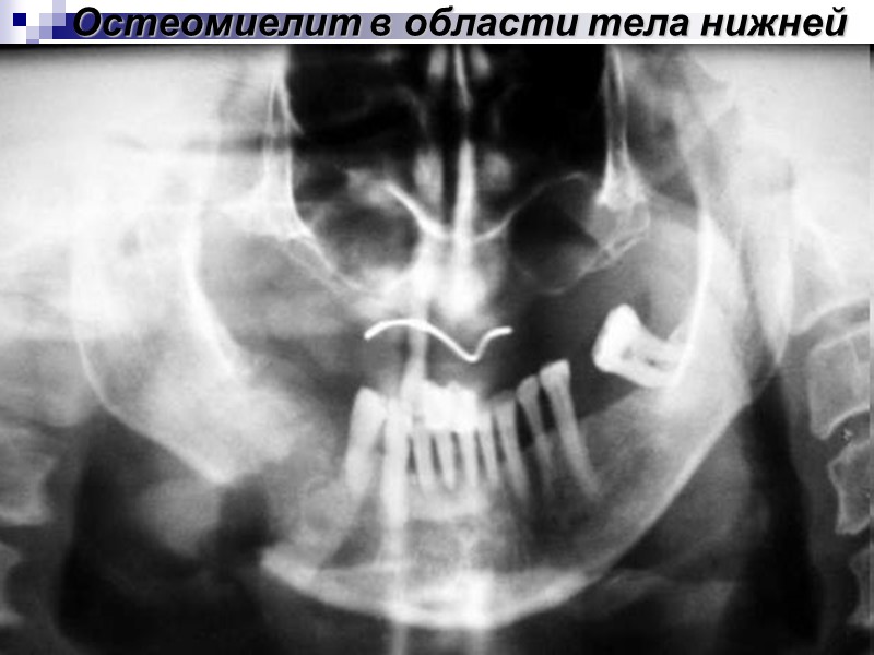 Остеомиелит в области тела нижней челюсти